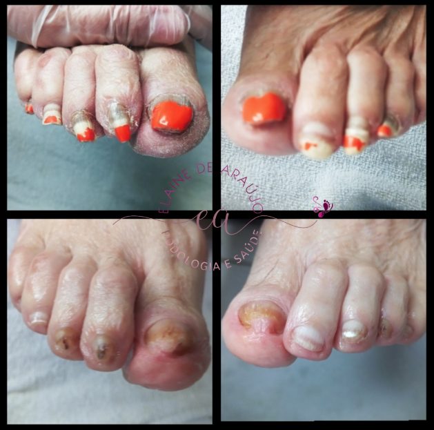 Antes e depois do tratamento das unhas de uma paciente
