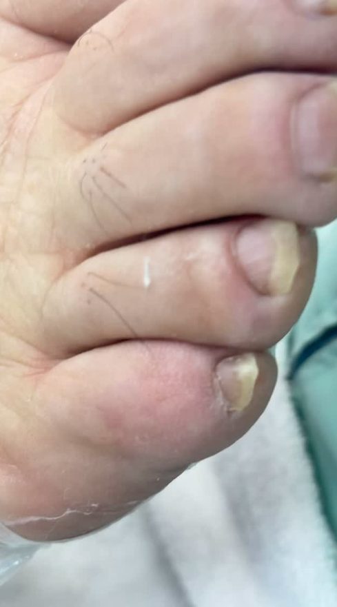 Unhas amareladas por micose