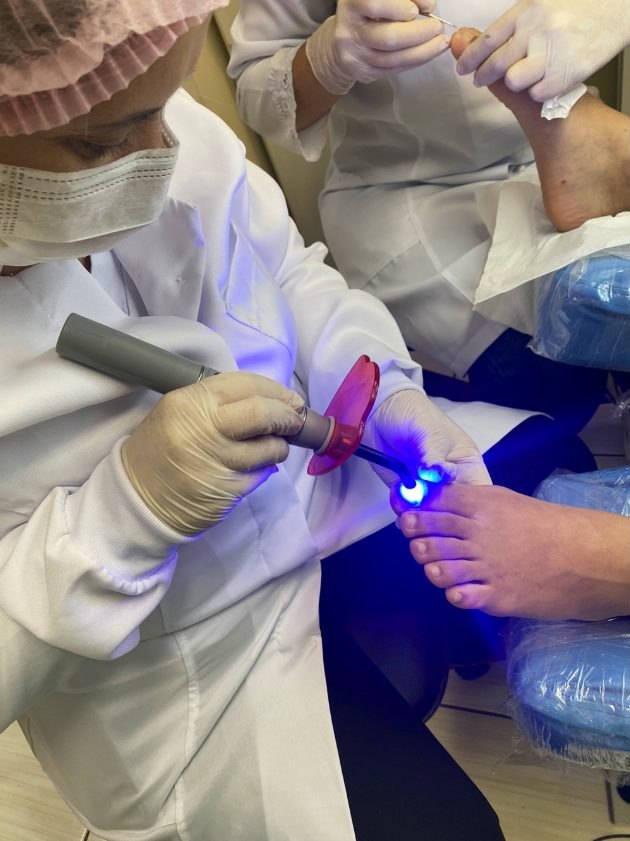 Aplicação de órtese na unha com luz azul