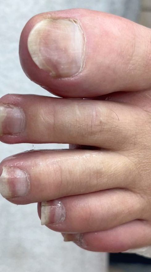 Unhas espessadas dos pés